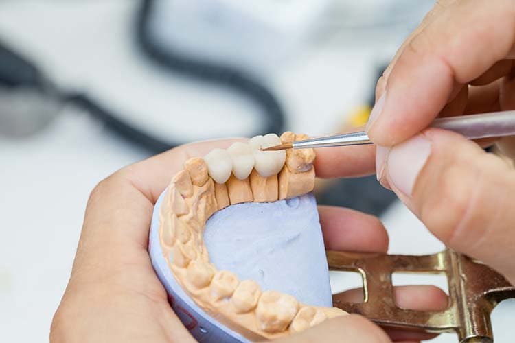 Crowns & Bridges — photo representing this service at Hedgewood Dental, Woodbridge VA