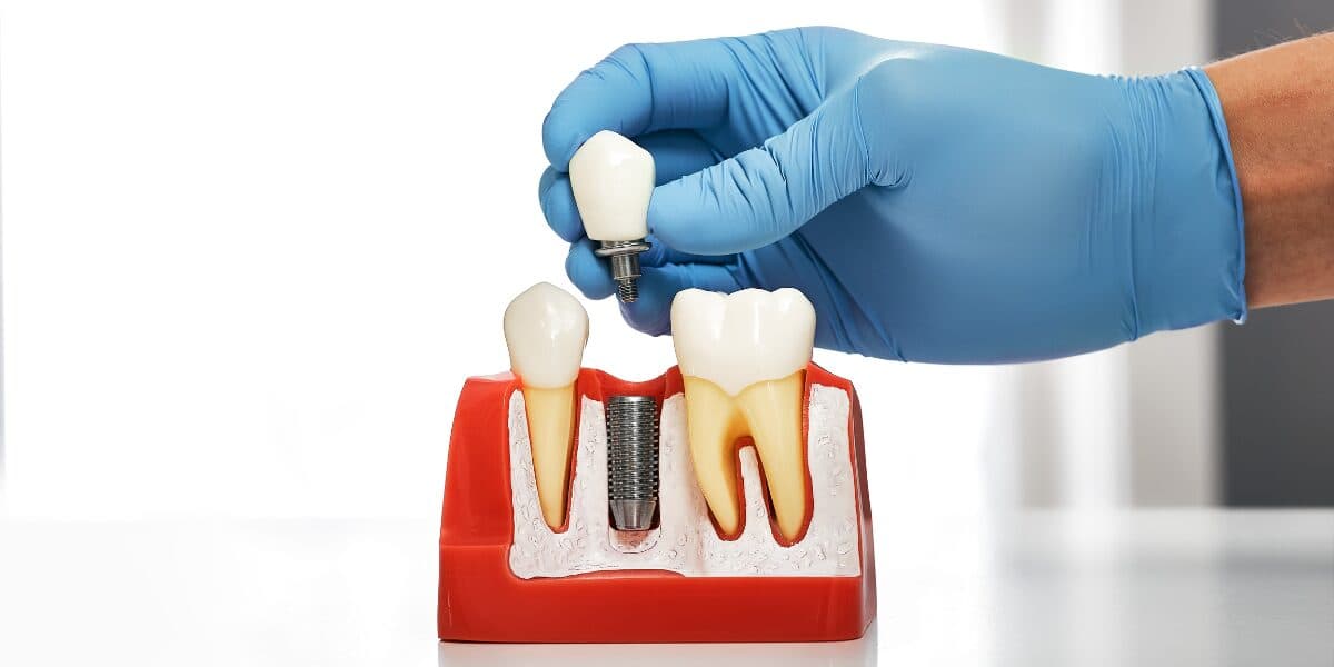 Featured image for the article: How Dental Implants Became the Definitive Choice for Tooth Restoration