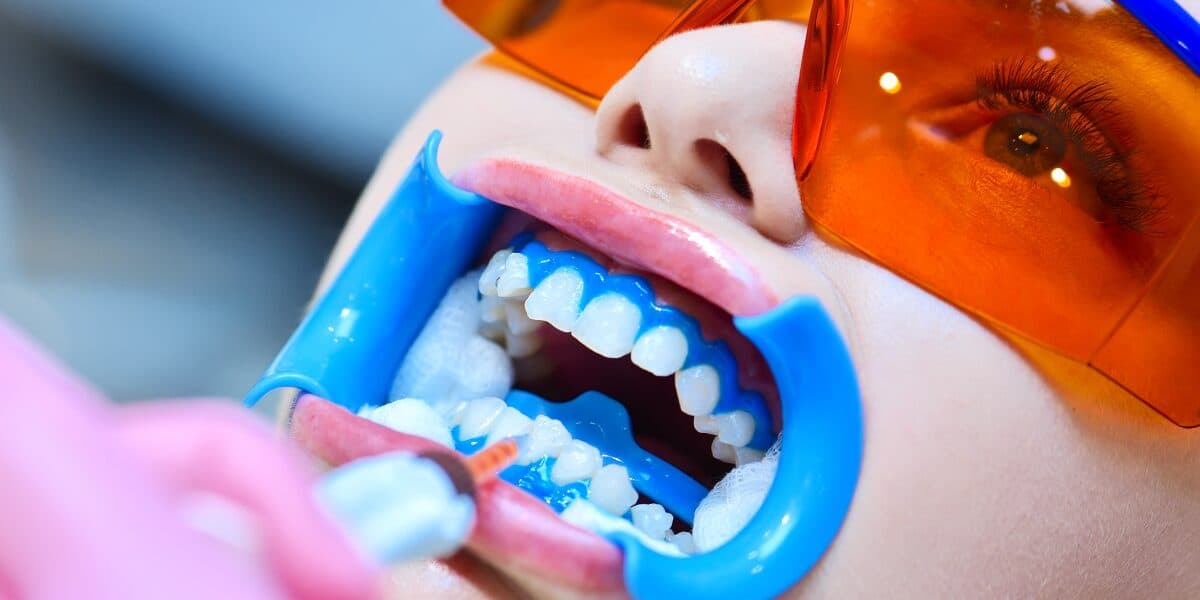 Featured image for the article: Does Tooth Whitening Cause Damage to Your Teeth?