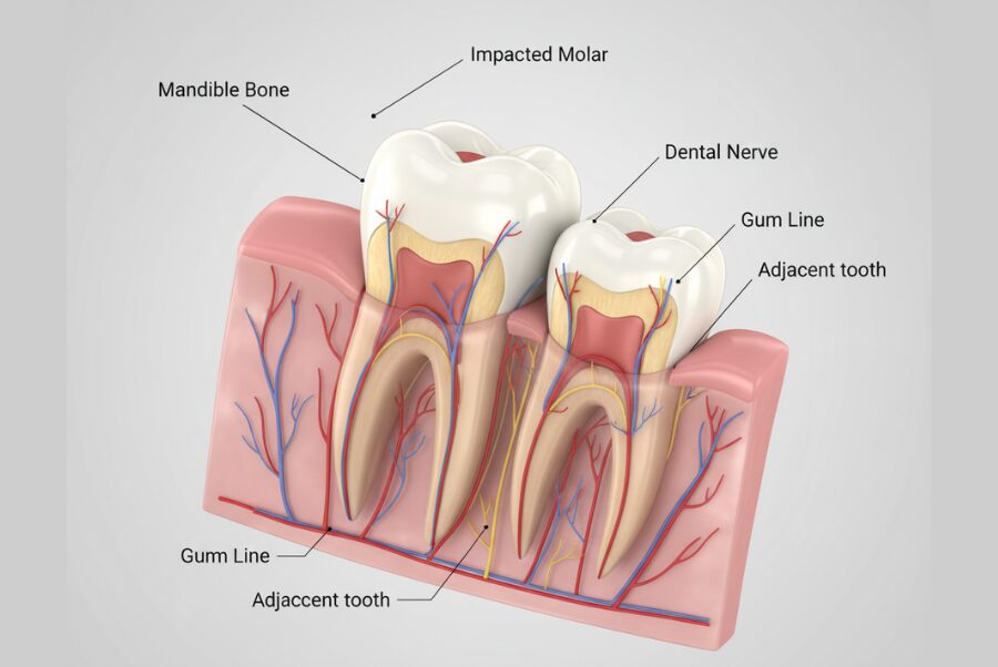 Impacted wisdom tooth diagram showing why removal is needed in Woodbridge VA
