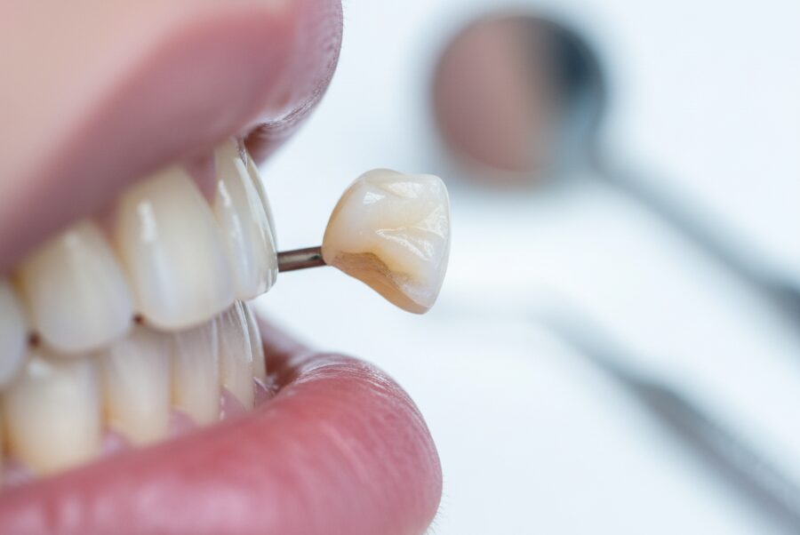 Close-up of chipped tooth before dental bonding in Alexandria VA